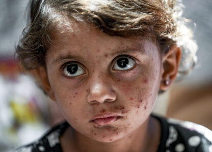 APTOPIX Israel Palestinians Skin Diseases