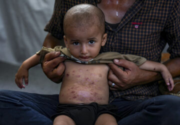 Israel Palestinians Skin Diseases