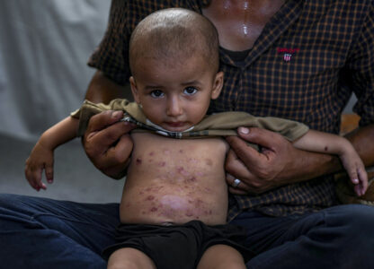 Israel Palestinians Skin Diseases