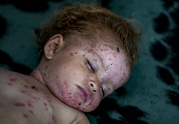 Israel Palestinians Skin Diseases