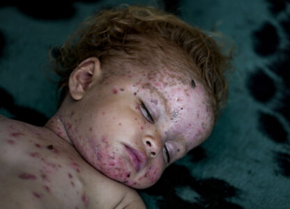 Israel Palestinians Skin Diseases