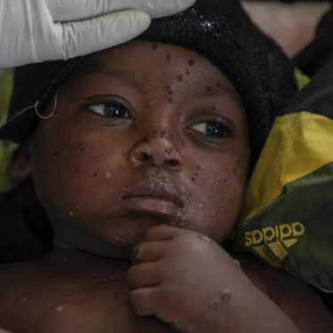 APTOPIX Congo Mpox Outbreak Epicenter