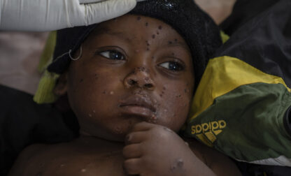 APTOPIX Congo Mpox Outbreak Epicenter